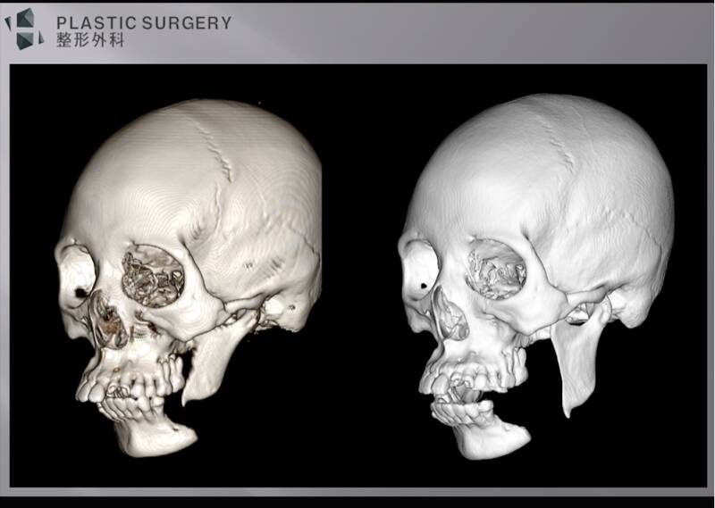 H整形医院运用3D打印技术，助力下颌骨骨折手术