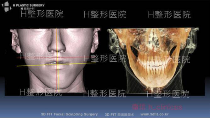 【H整形】下巴不对称的下巴缩小术分享：缩小下巴的手术方法因人而异