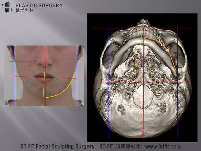 矫正面部不对称、无下巴、小下颌，靠H整形3D Fit PMMA假体手术更完美